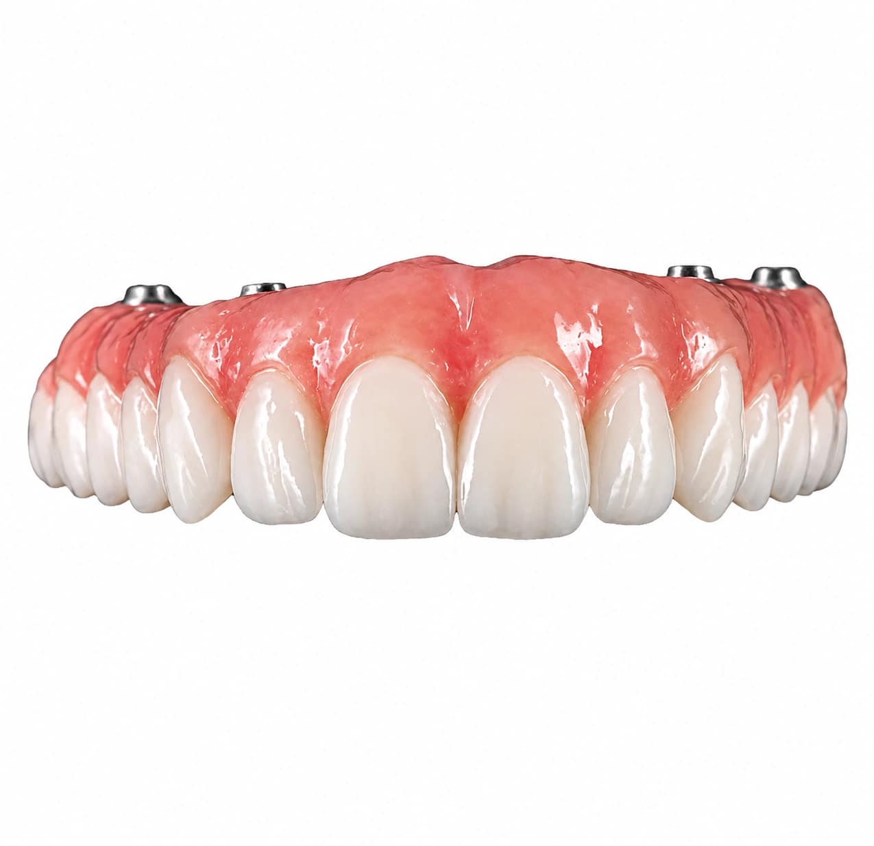 All-on-X PMMA provisional full-arch restoration