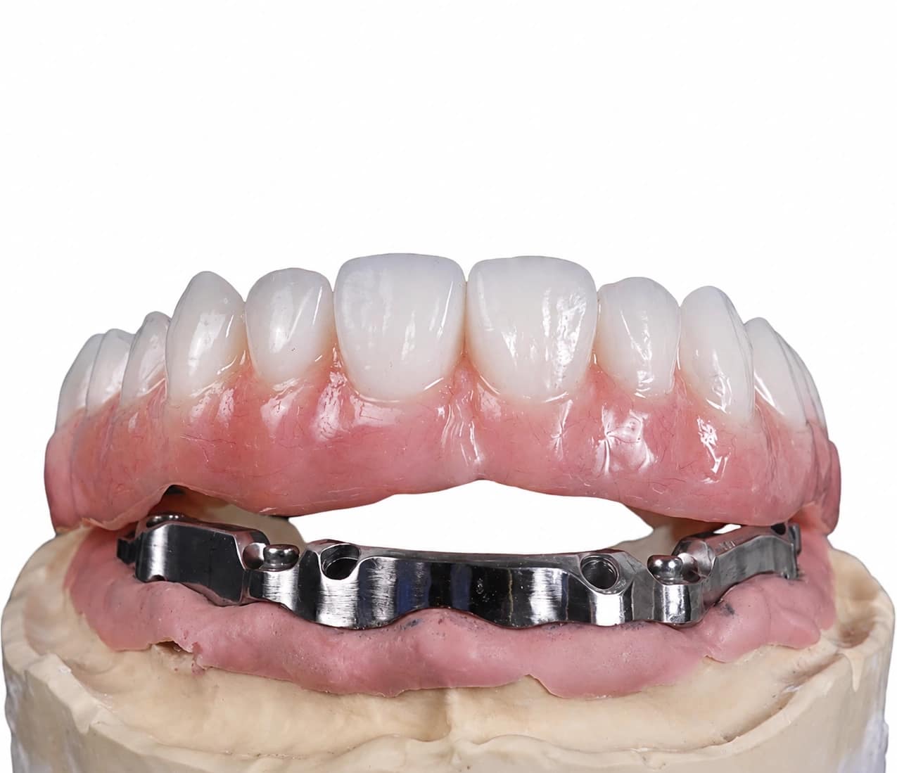 Blended I-Bar full-arch implant restoration