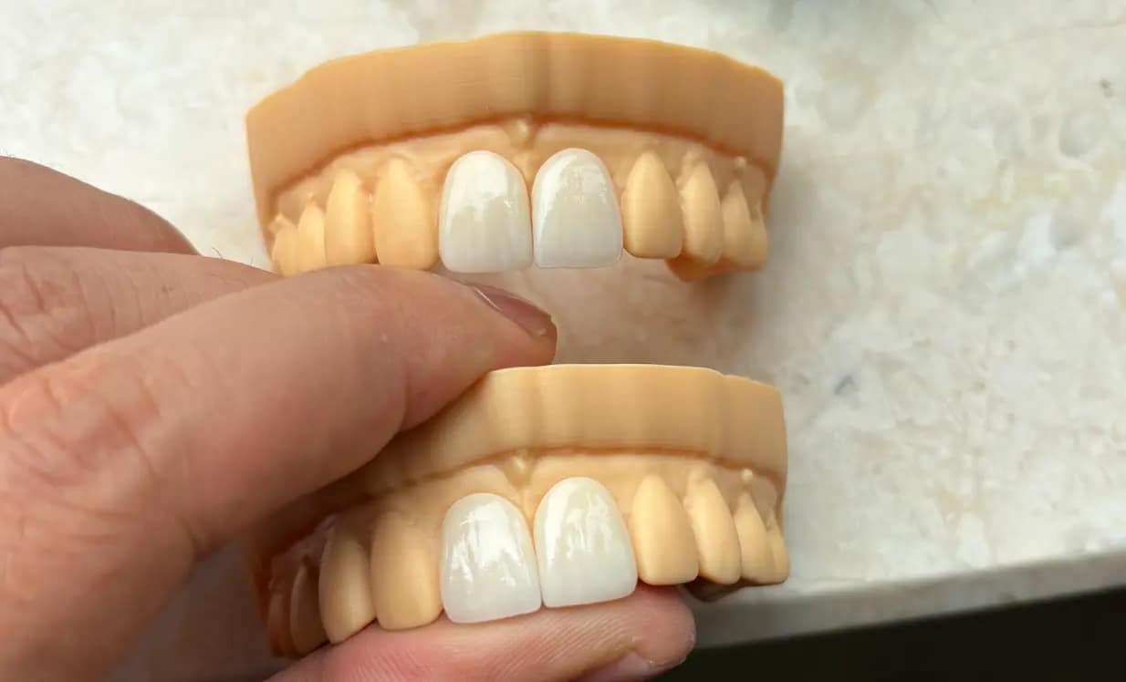 Dental veneer esthetic restoration
