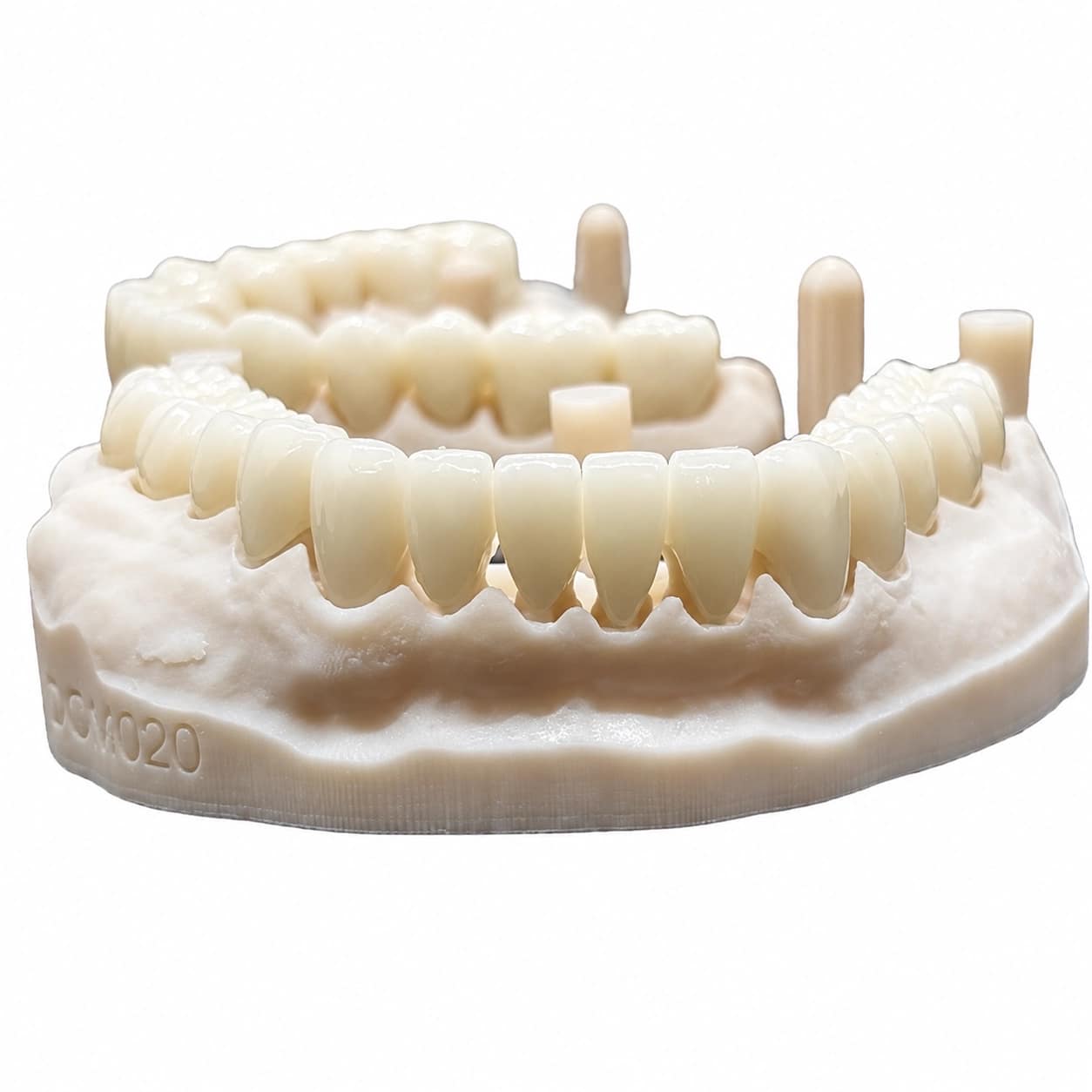 Emax lithium disilicate crown restoration