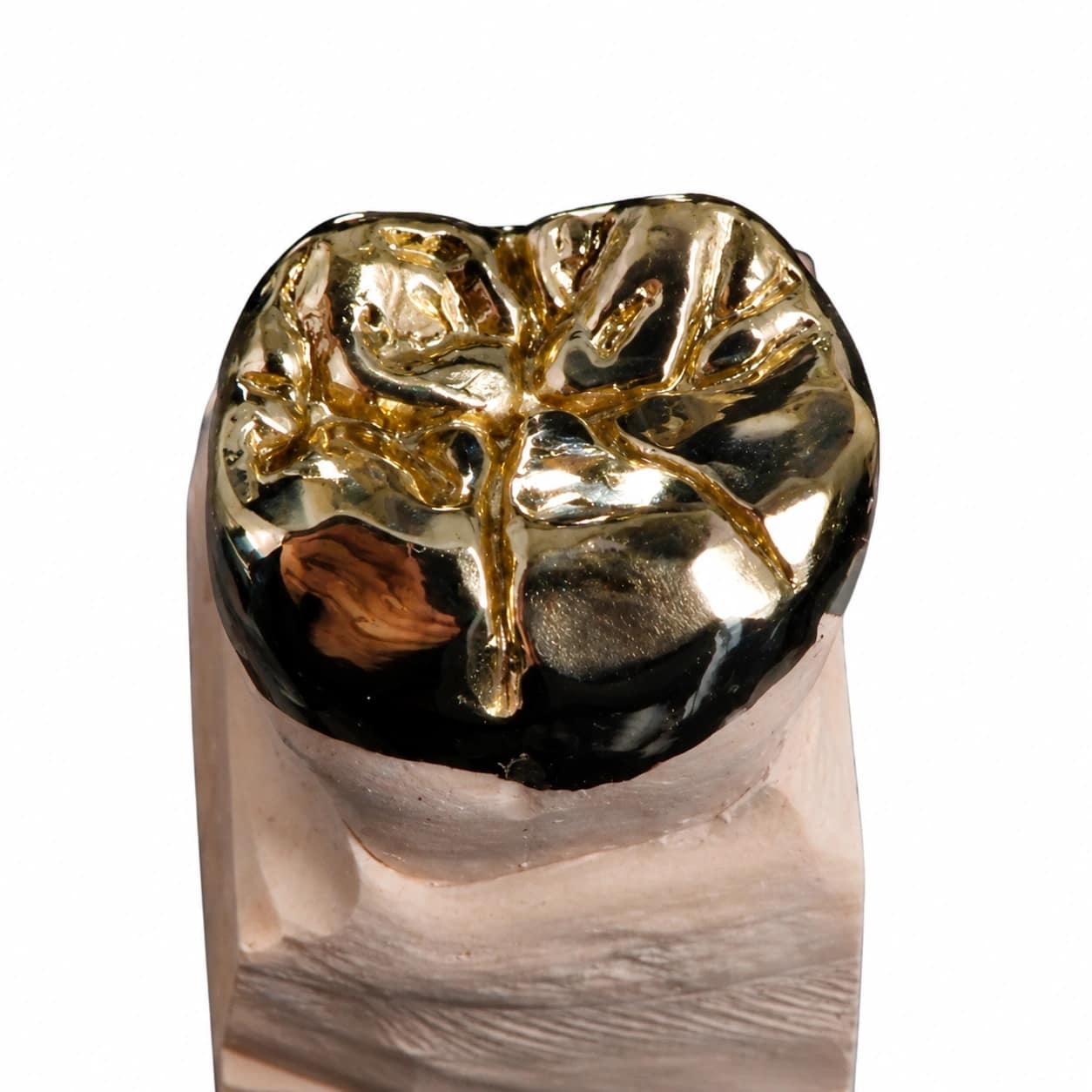Full metal crown dental restoration