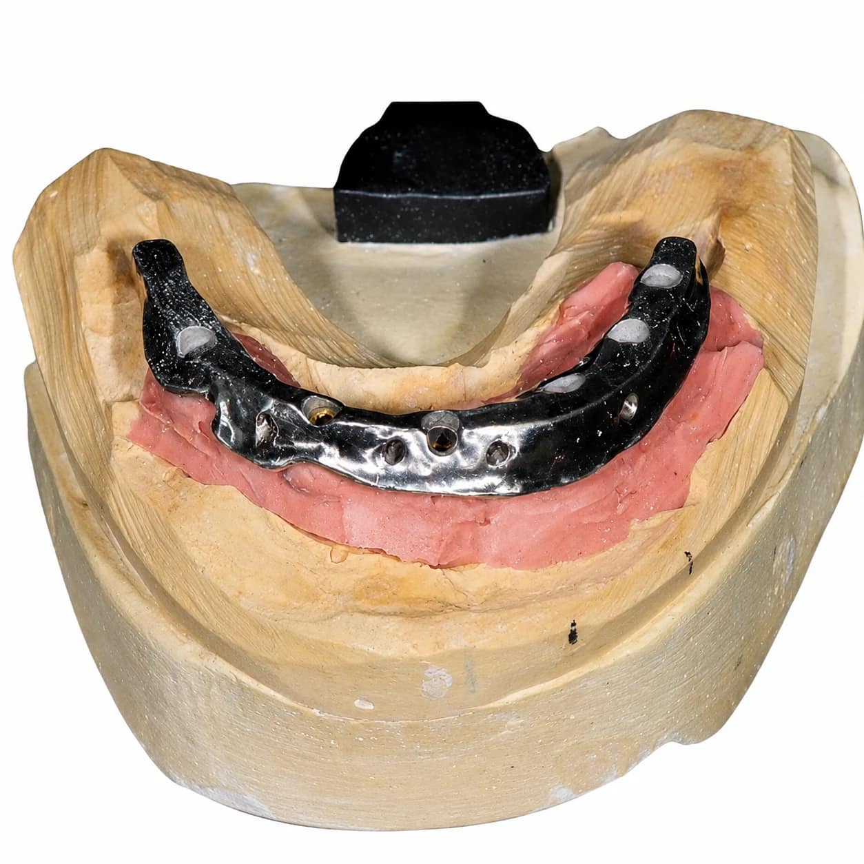 Hybrid IBar full-arch implant restoration